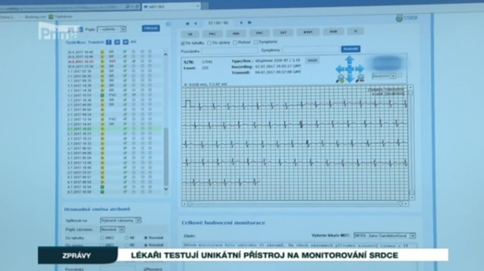 13. 8. 2017 ZPRÁVY: Lékaři testují unikátní přístroj na monitorování srdce